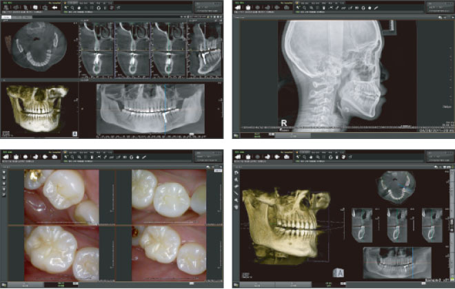 歯科用CTで撮影した画像